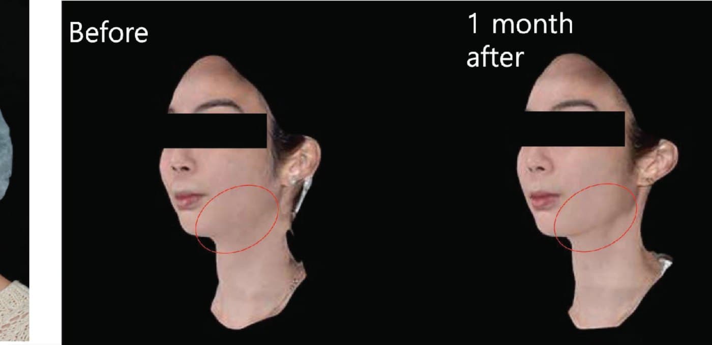Before and after XTherma at one month with the jawline area annotated to show where change occurred
