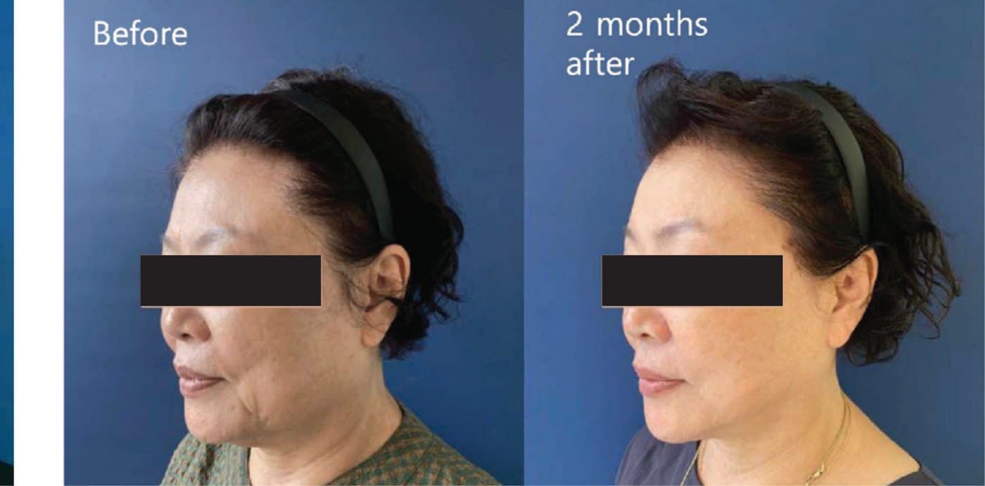Before and after XTherma at two months, three-quarter view showing early jawline definition