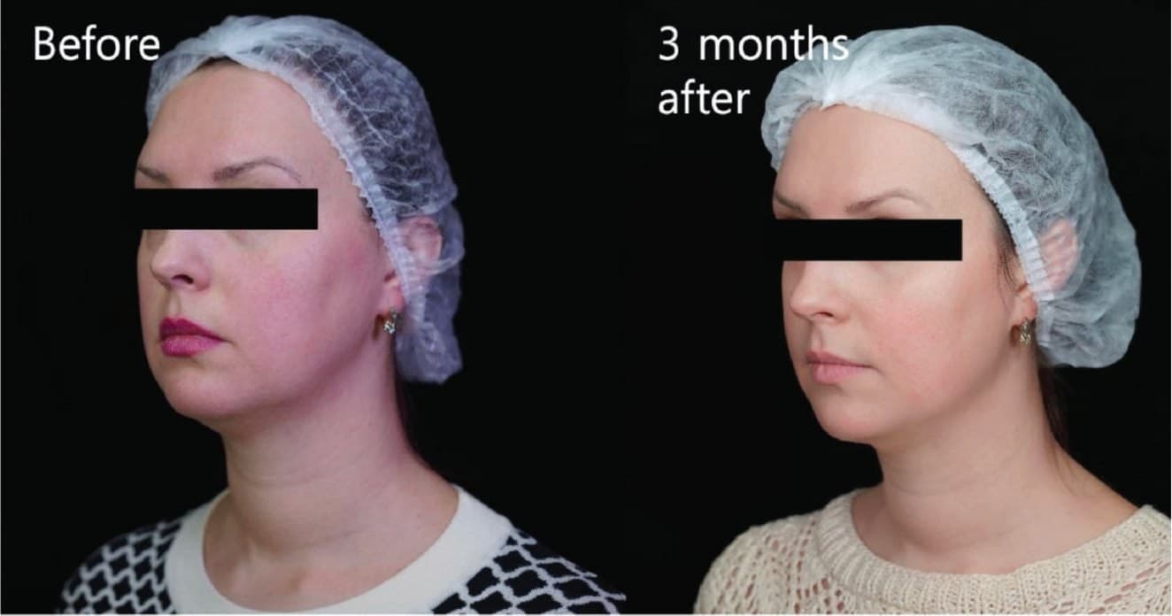 Before and after one XTherma session at three months at Neoderma Anaheim: a firmer jawline and smoother neck on the practice's own nurse