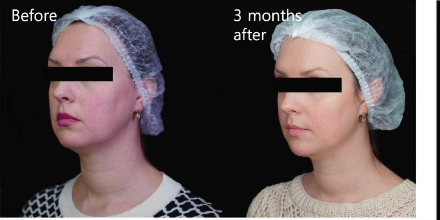 Before and after one XTherma session at three months, with visibly firmer skin along the jawline and neck in the after photo