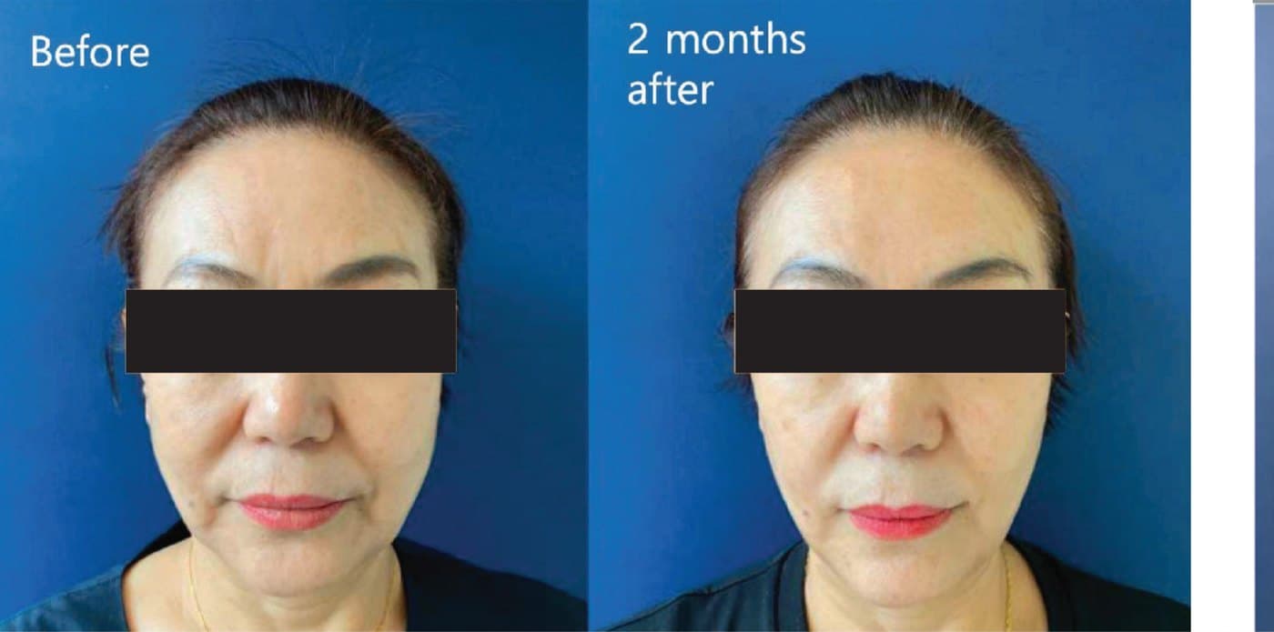 Before and after XTherma at two months, front view showing early firming of the lower face