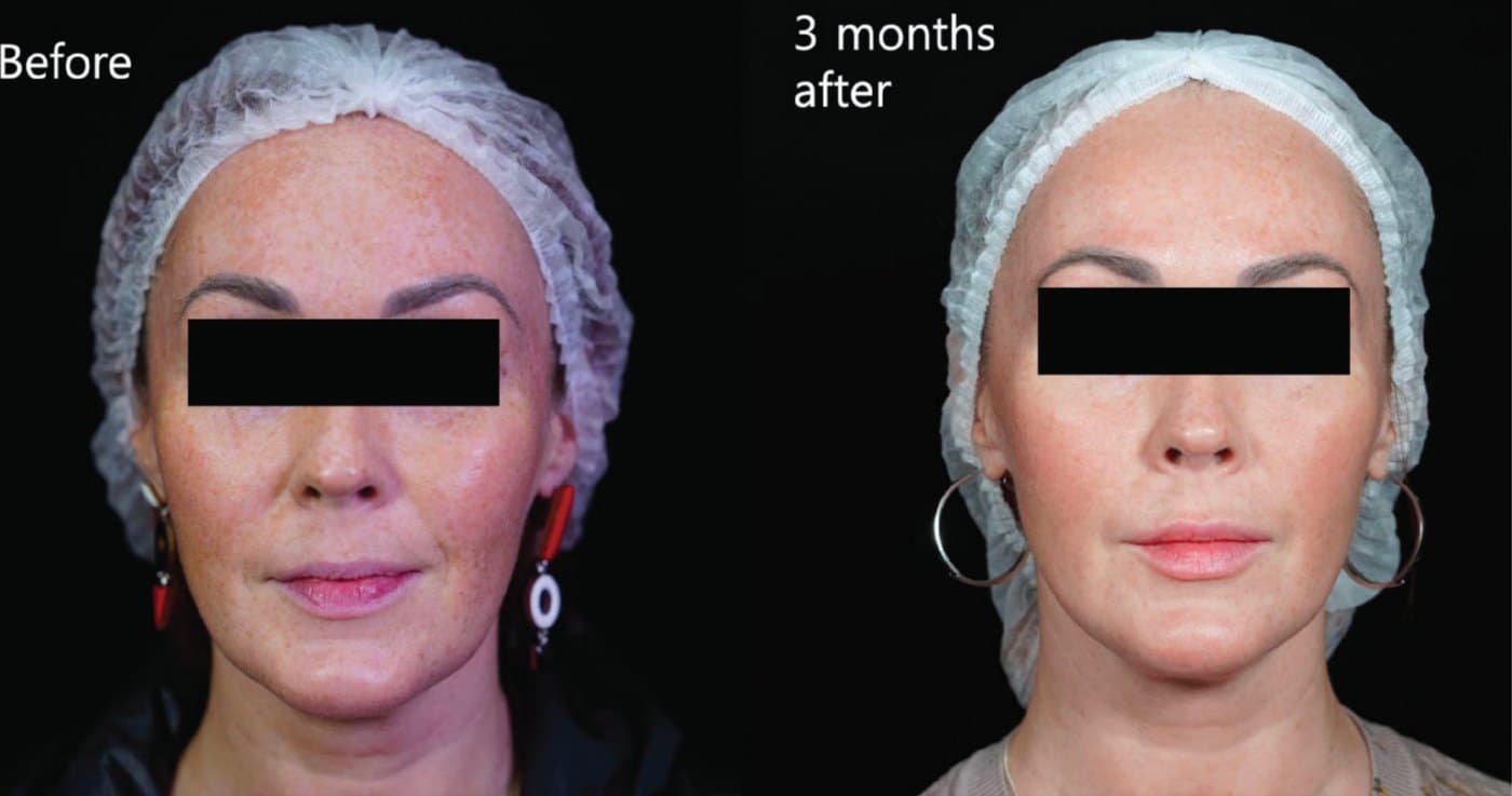 Before and after XTherma at three months, front view showing improved definition along the lower face and jawline