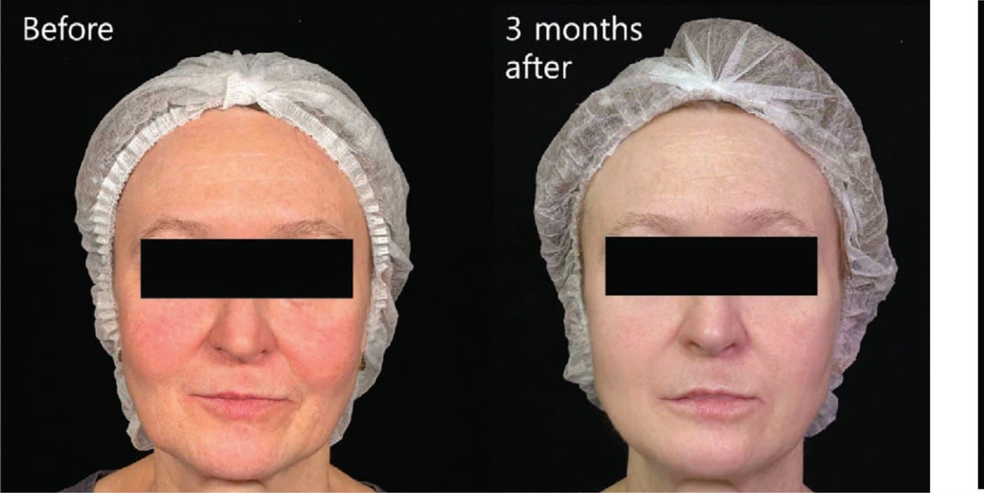 Before and after XTherma at three months, front view showing a firmer lower face