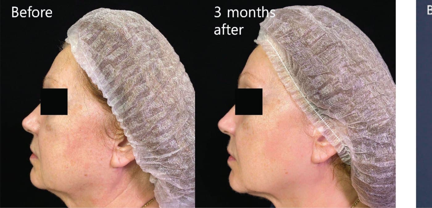 Before and after XTherma at three months, profile view showing a smoother neck and softened jowl
