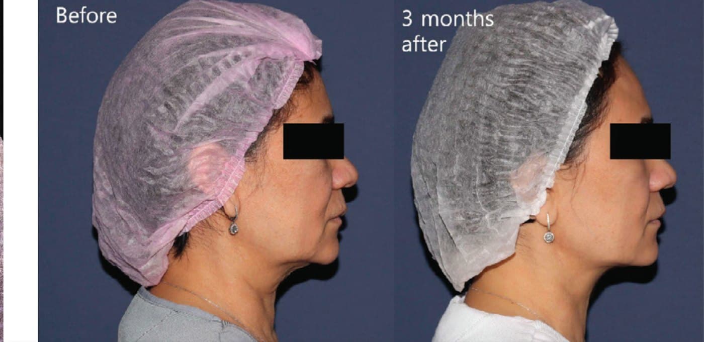 Before and after XTherma at three months, profile view showing a tighter jawline and reduced fullness under the chin