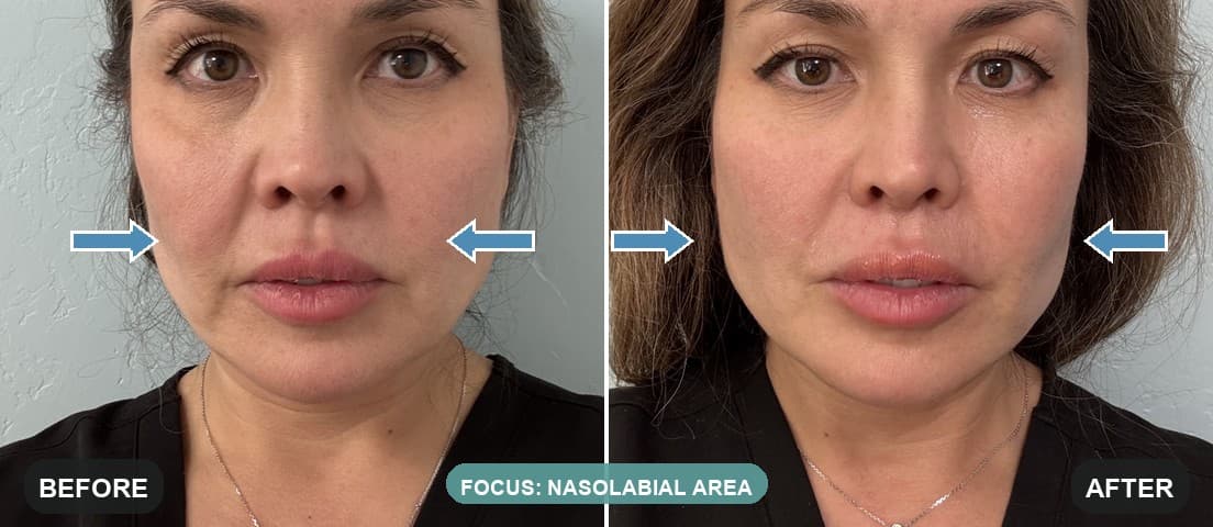 Before and after one XTherma session at Neoderma Anaheim on Melissa Moore, RN — arrows marking the nasolabial folds, visibly softened with natural facial volume intact