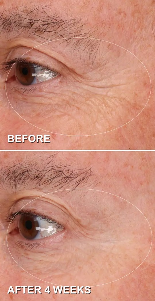 Before and after 4 weeks of Pavise Precision Eye Lift: fine lines around the eye visibly softer