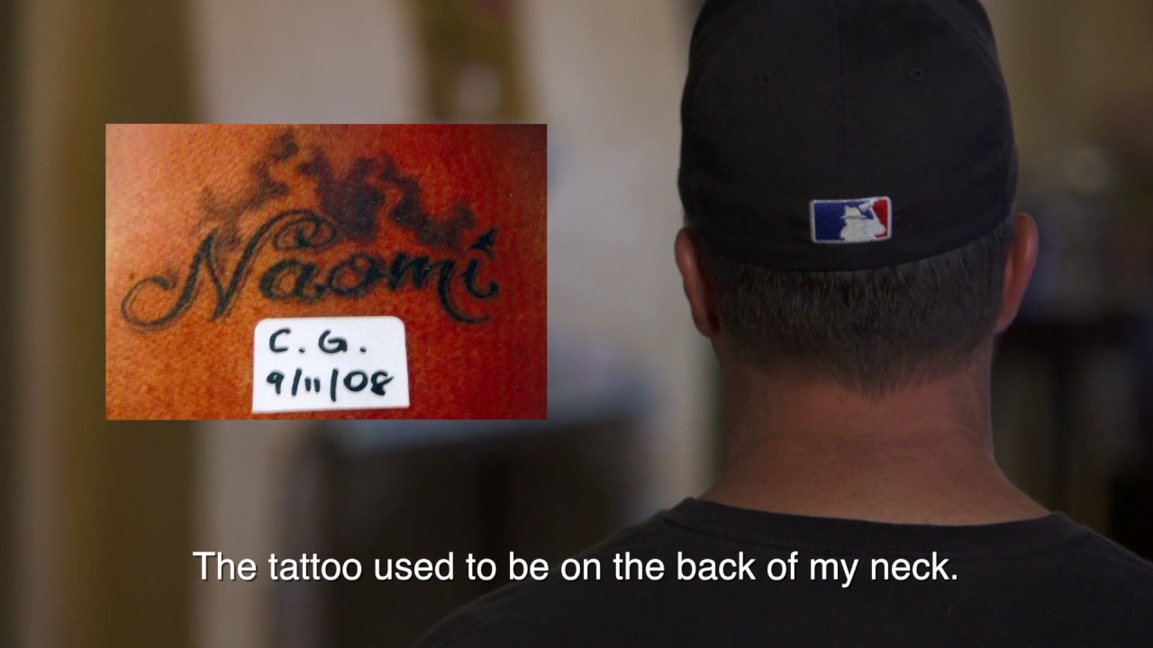 Christian — Laser Tattoo Removal at Neoderma