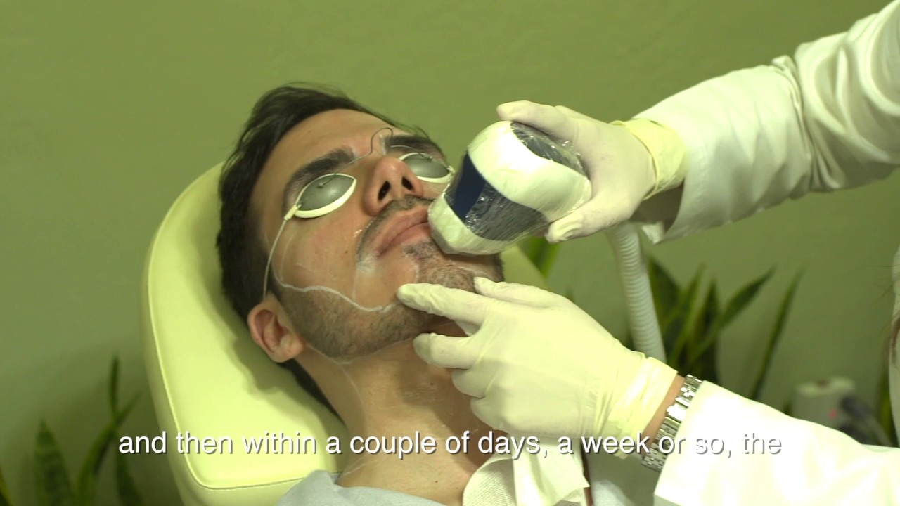Kevin's laser hair removal story at Neoderma