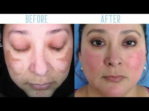 PicoWay Resolve for melasma at Neoderma — before and after