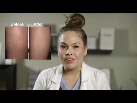 Safe and effective treatment for spider veins and varicose veins at Neoderma