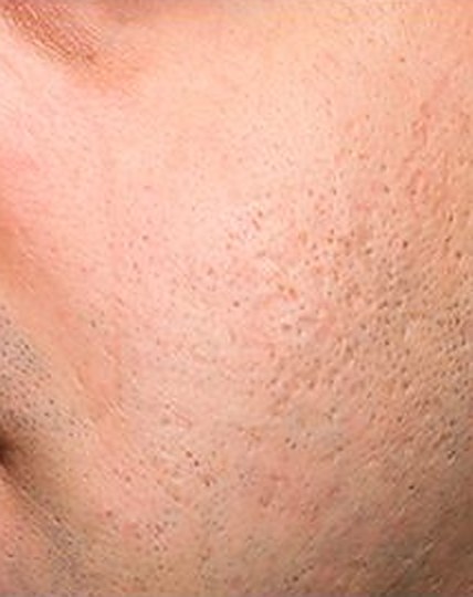 The same cheek with visibly smoother acne scarring after 4 Exceed microneedling treatments