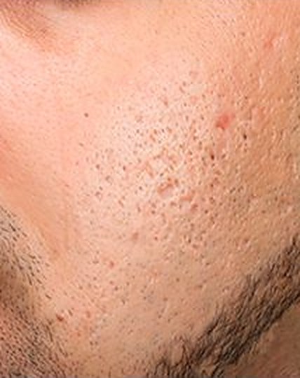 Acne scarring on a man's cheek before Exceed microneedling