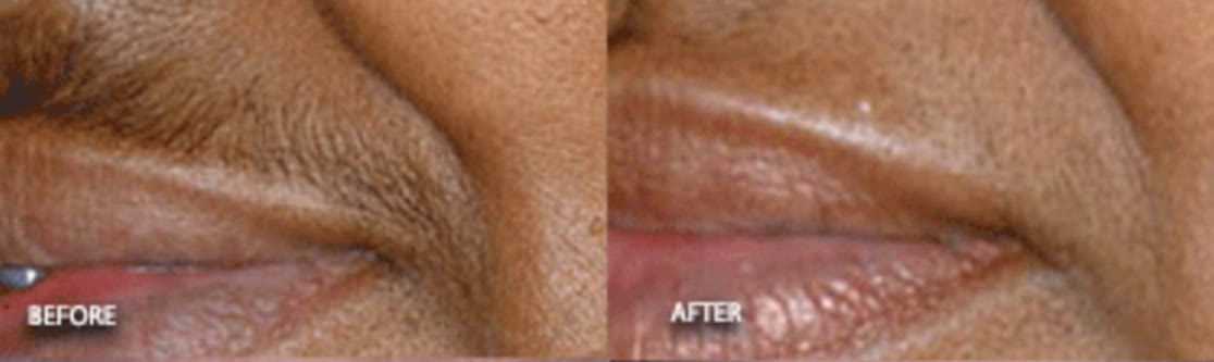 Before and after laser hair removal on the upper lip, on deeper skin