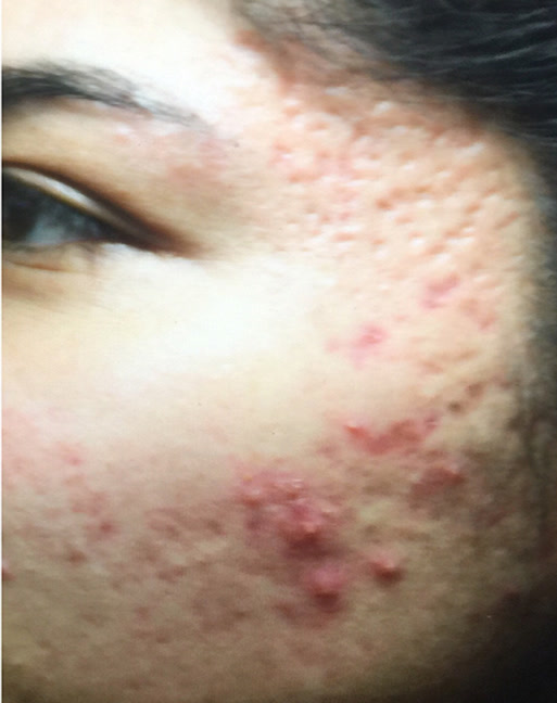 Before Secret RF microneedling at Neoderma: cheek with active acne and uneven, scarred texture