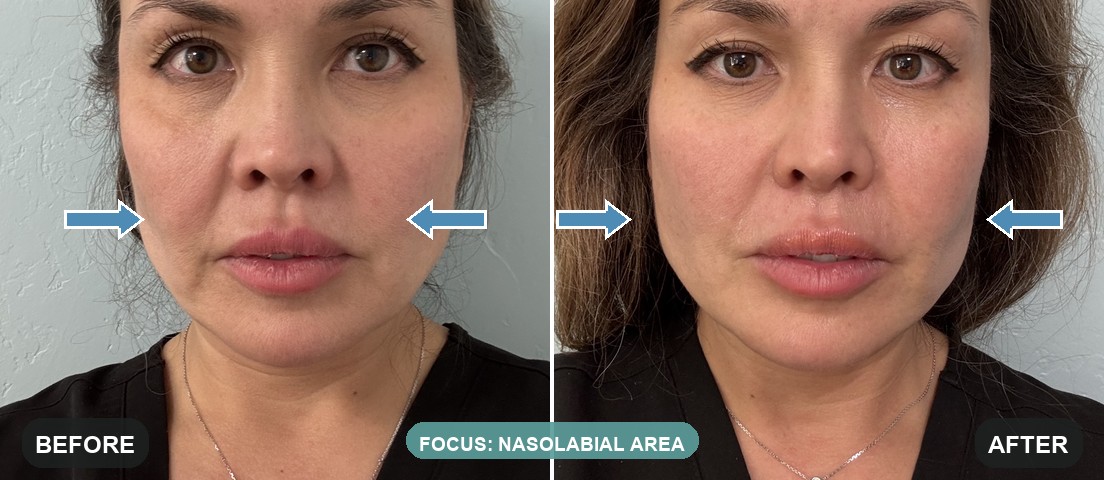XTherma before and after on Melissa Moore, RN, our own provider, one session, three months out: softer nasolabial folds and a firmer lower face